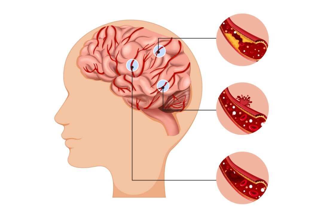 Sistem Rujukan dan Dampaknya pada Pasien Stroke di Indonesia