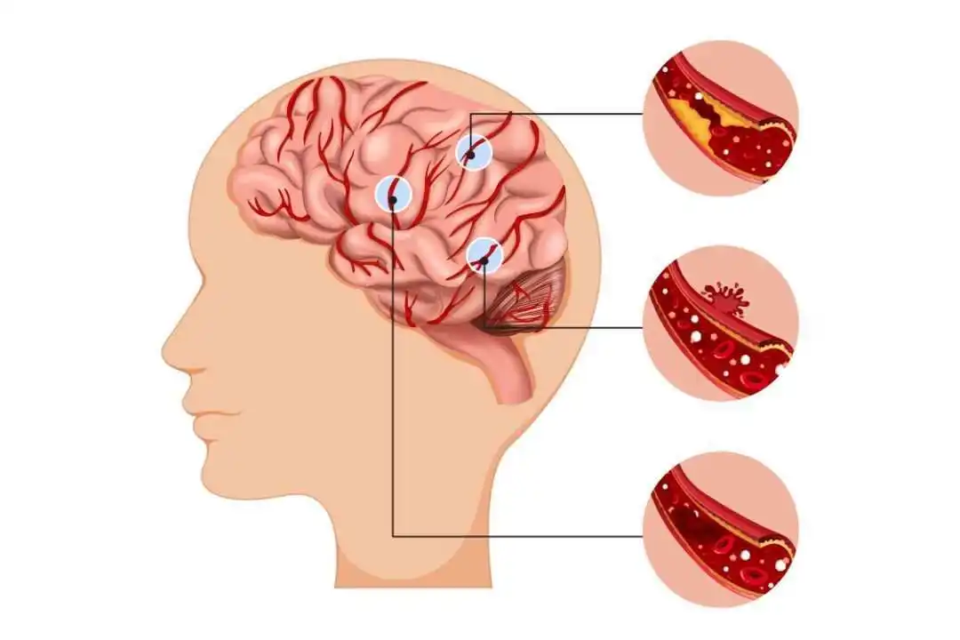 Sistem Rujukan dan Dampaknya pada Pasien Stroke di Indonesia